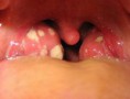 /album/fotogaleria/amigdalitis-jpg/