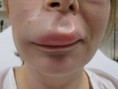 /album/fotogaleria/angioedema-jpg/