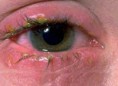 /album/fotogaleria/conjuntivitis-jpg/