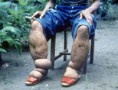 /album/fotogaleria/elefantiasis-jpg/